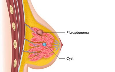 Fibroadenoma Breast: Ayurveda Can Definitely Help!