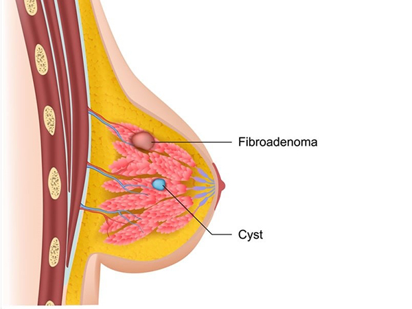 Fibroadenoma-Breast