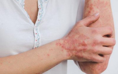 Psoriasis Treatment in Ayurveda | Vedang Clinic